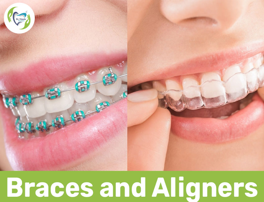 Braces and aligners in kaithal