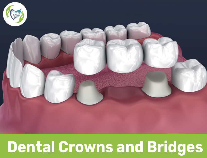 Dental crowns and bridges in kaithal