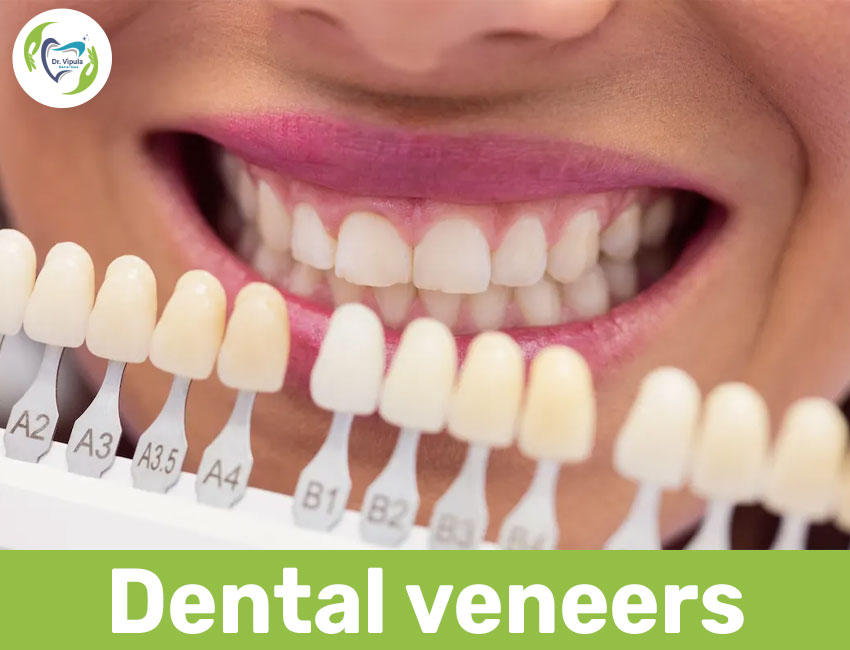 Dental veneers in kaithal