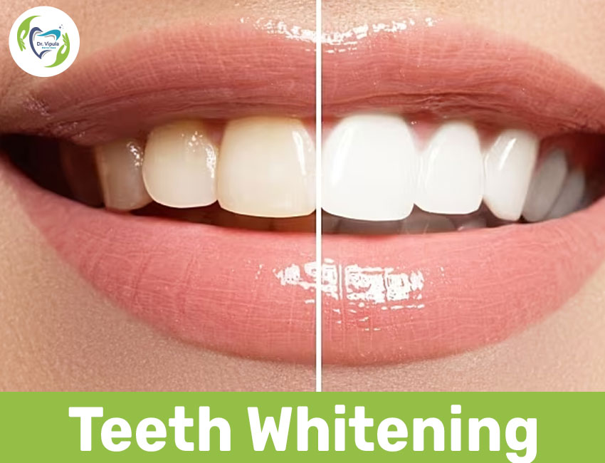 Teeth Whitening in kaithal