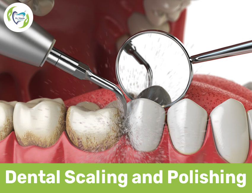 Dental scaling and polishing